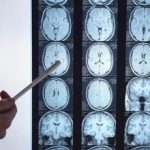 Calcio e ripetute commozioni cerebrali neurologa Rischi a lungo termine