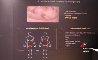 Idrosadenite suppurativa lesperto Piu attenzione a qualita della vita