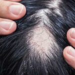 Alopecia areata ok Aifa a rimborsabilita nuovo trattamento