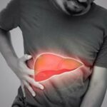 Colangite lepatologo Con acido obeticolico riduzione eventi epatici