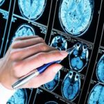 Iss scoperto meccanismo chiave Alzheimer speranza per diagnosi e cure