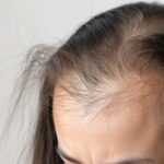 Alopecia areata Libro bianco e Manifesto per sensibilizzare su patologia